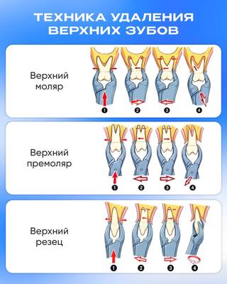Шпаргалка для стоматолога-хирурга. Техники удаления зубов.